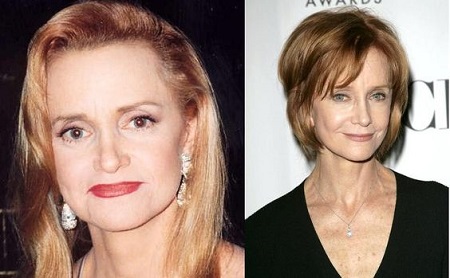 Swoosie Kurtz's before and after comparison for her plastic surgery rumors.