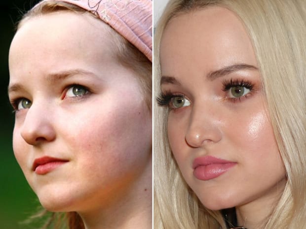 Dove Cameron has gone a tremendous transformation in her facial features over the years.