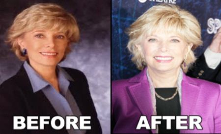 before and after photo of Lesley  Stahl after Plastic Surgery