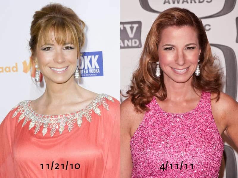 Pictures of Jill Zarin before and after plastic surgery.